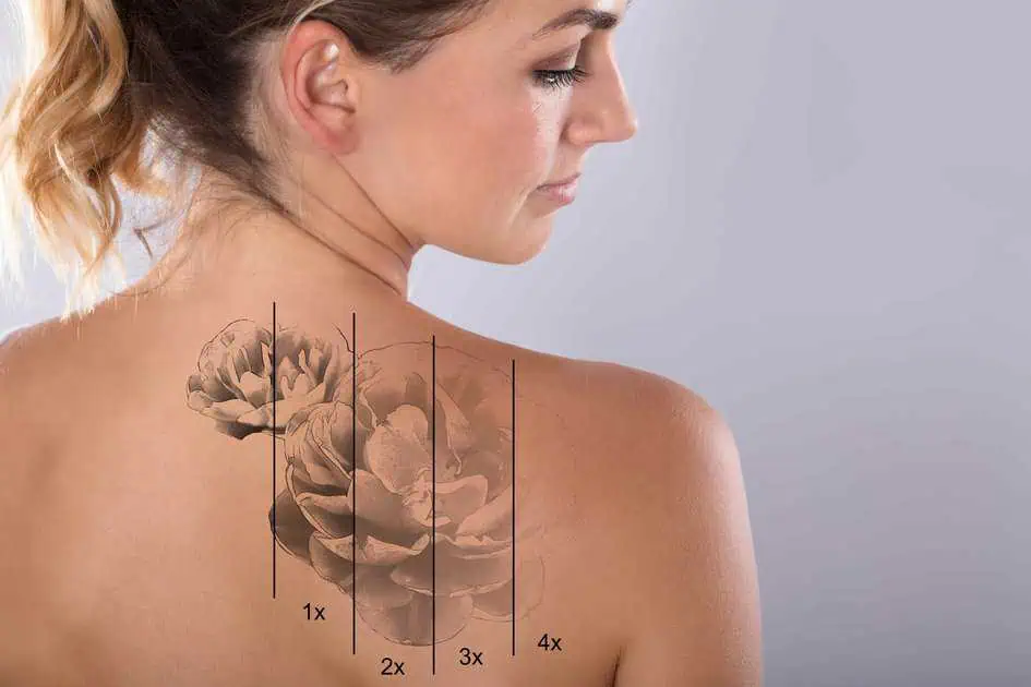 Laser Tattoo Removal in Augusta, GA by Rayne Medspa